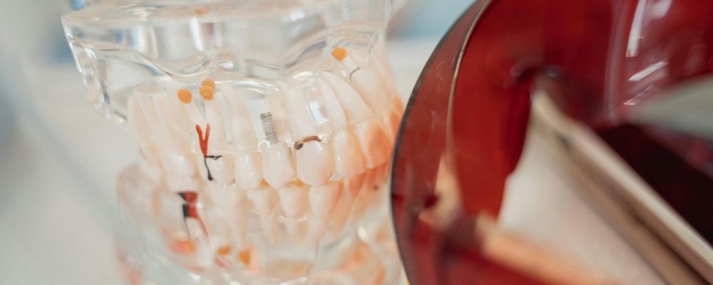 dentnuvo_implantes_dentales