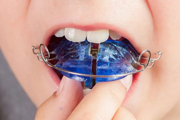 ¿Cuándo es recomendable asistir al ortodoncista?