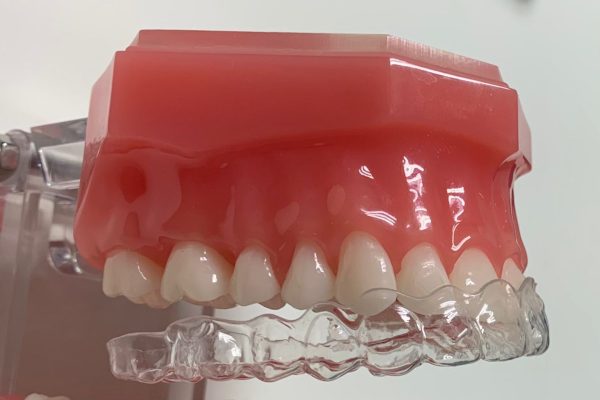 ¿Como se colocan los alineadores?